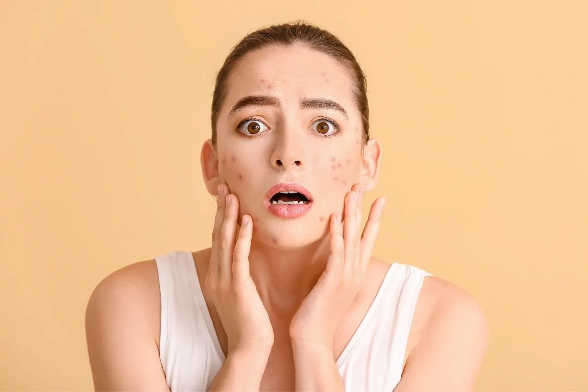 Donna con pelle acneica che cerca rimedi naturali